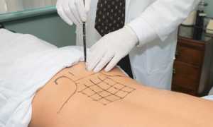 Применение технологий пролотерапии в ортопедии и артрологии