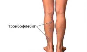Профилактика и предупреждение тромбофлебита