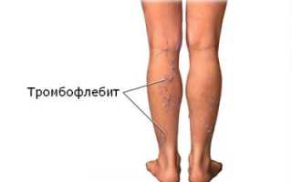 Профилактика и предупреждение тромбофлебита