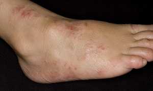 Кожные проявления варикоза: дерматит