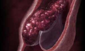 Самостоятельная и врачебная диагностика тромбоза