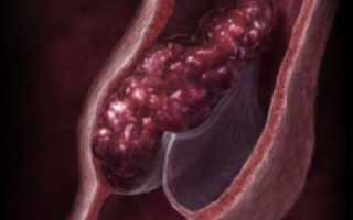 Самостоятельная и врачебная диагностика тромбоза