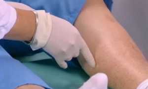 Облитерирующий атеросклероз: симптомы, причины, лечение