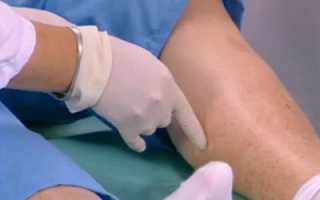 Облитерирующий атеросклероз: симптомы, причины, лечение