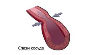Спазмирование сосудистого русла: причины, виды и симптоматика