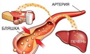 Чем опасен атеросклероз сердечных сосудов?