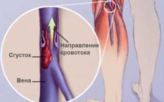 Острые тромботические поражения сосудов ног