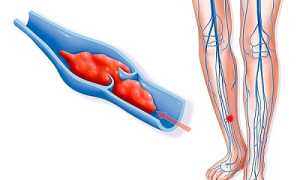 Нужны ли кроверазжижающие препараты для лечения варикоза?