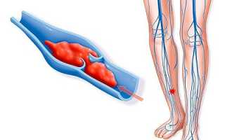 Нужны ли кроверазжижающие препараты для лечения варикоза?