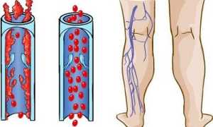 Польза и вред велосипеда при варикозе нижних конечностей