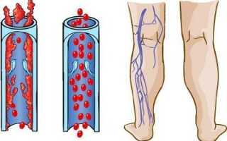 Польза и вред велосипеда при варикозе нижних конечностей