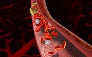 Развитие тромботических структур в сосудах