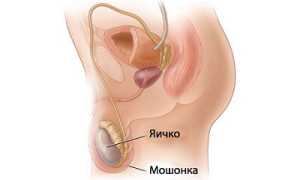 Возникновение варикоцеле в подростковом возрасте