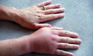 Проявления и терапия тромбофлебита верхних конечностей