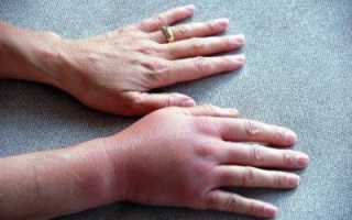 Проявления и терапия тромбофлебита верхних конечностей