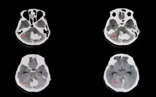 Инсульт с поражением мозжечковых отделов