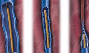 Радиочастотная терапия варикозной болезни на ногах