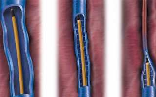 Радиочастотная терапия варикозной болезни на ногах