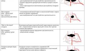 Спинальный тип инсульт-патологии