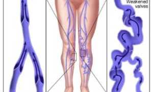 Методы укрепления сосудов нижних конечностей