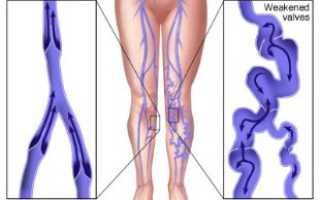 Методы укрепления сосудов нижних конечностей
