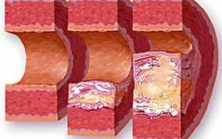 Формы и стадии атеросклеротического поражения сосудов
