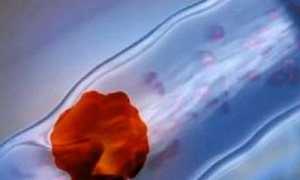 Опасность флотирующего тромба