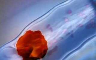 Опасность флотирующего тромба