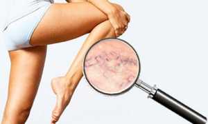 Общие принципы и методы лечения варикозной болезни