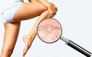 Общие принципы и методы лечения варикозной болезни