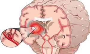 Кома при геморрагическом ударе