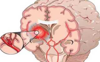 Кома при геморрагическом ударе