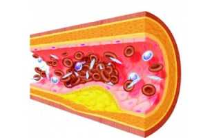 Сосудистые заболевания мозга: этиология, симптомы и последствия