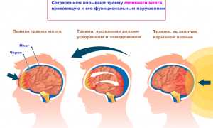 Как жить, перенеся мозговой удар?