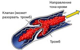 Как протекает варикоз в послеродовом периоде?