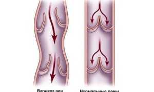 Физиотерапевтические методы лечения варикоза