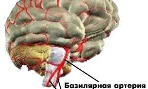 Инсульт с локализацией поражения в вертебробазилярном бассейне