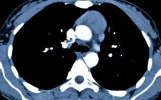Причины, симптомы и лечение целомической кисты перикарда