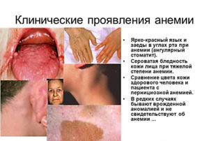 Анемия