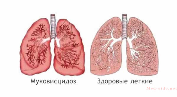 Что такое муковисцидоз простыми словами. Базовые принципы лечения и поддержания здоровья больным