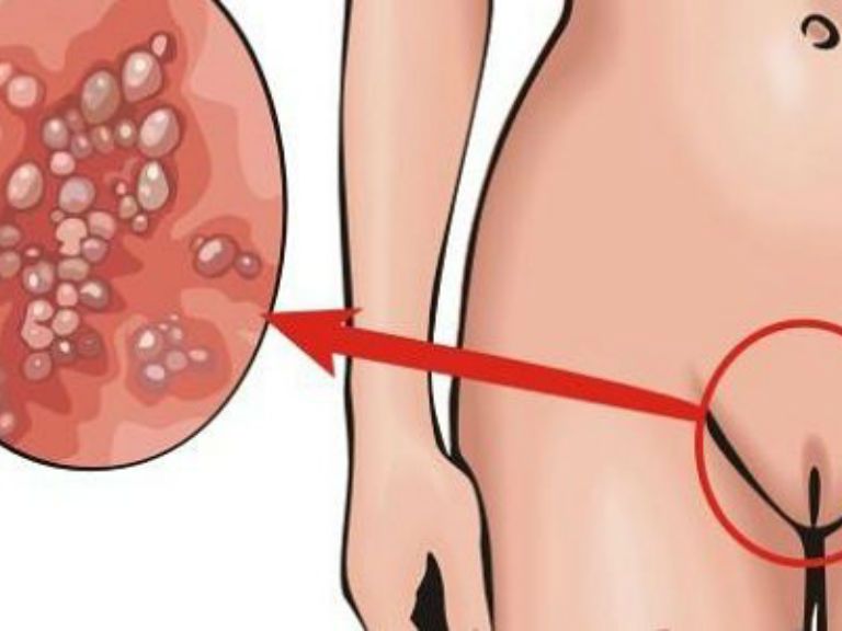 герпес и цистит взаимосвязь