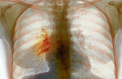 Раковая опухоль