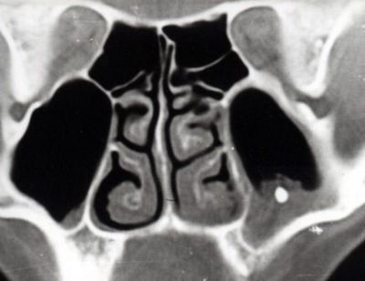 Инородное тело в пазухах
