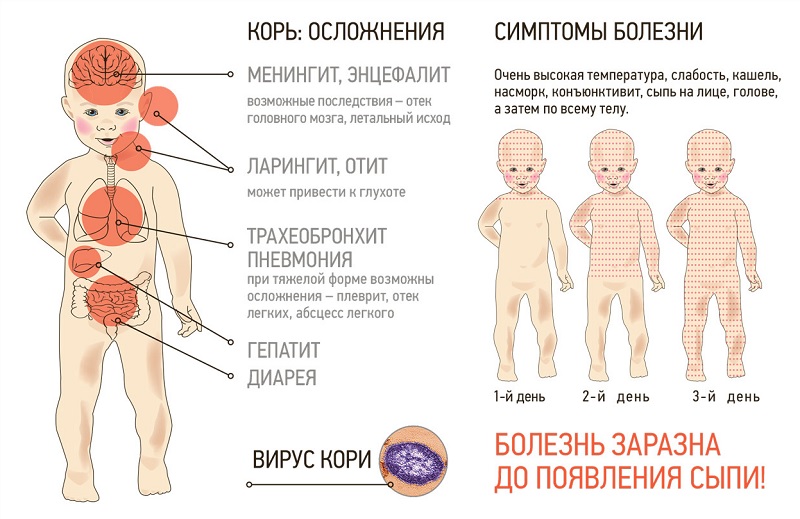 Принципы лечения и диагностики кори. Опасности заболевания, показания к госпитализации