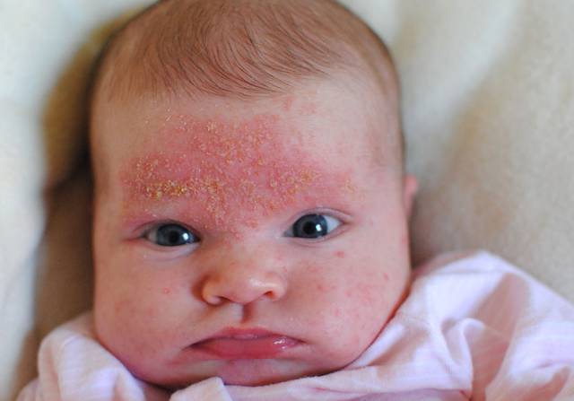 Себорейный дерматит у новорожденного