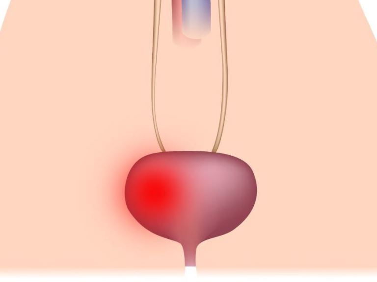Причины герпетического цистита