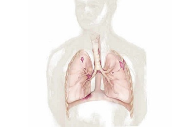 Пневмофиброз