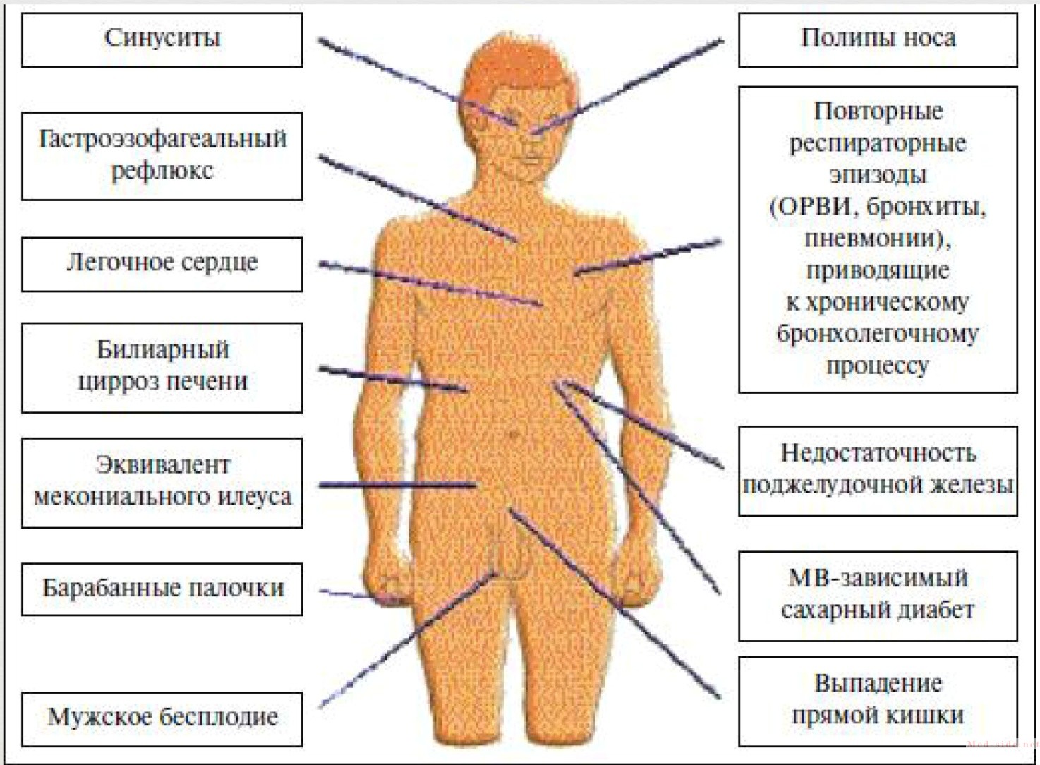 Что такое муковисцидоз простыми словами. Базовые принципы лечения и поддержания здоровья больным