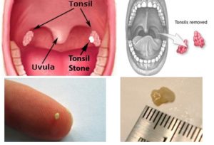 Лептотрихоз или кандидоз ротовой полости у детей. О чем говорит белый налёт на горле