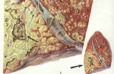 Инфильтративный туберкулез